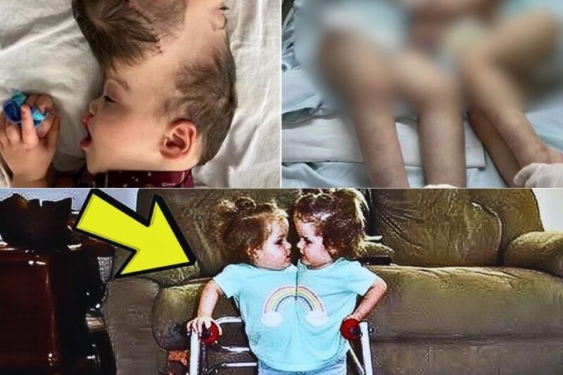 Lembra-se destas gêmeas siamesas? 18 anos após a separação… veja como elas estão agora.