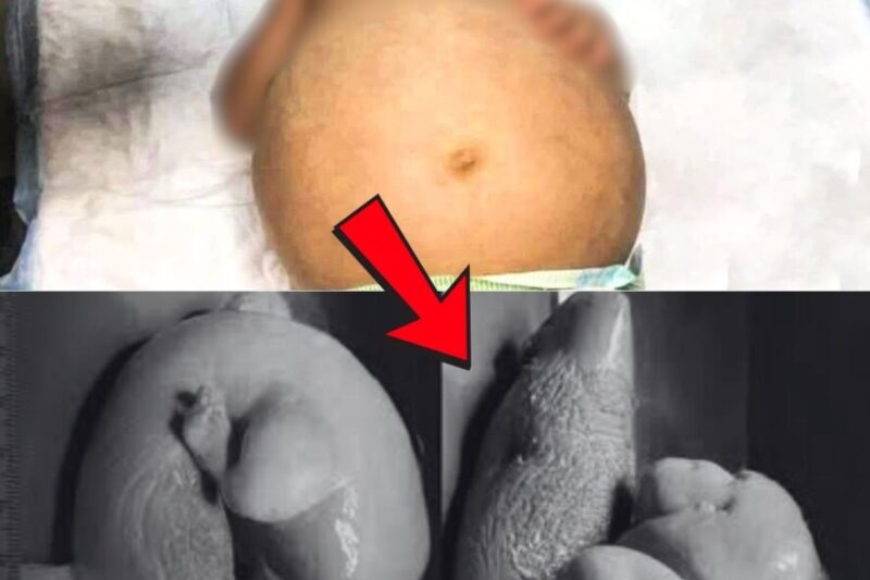 A barriga desse bebê não parou de crescer até que os médicos deram notícias alarmantes aos pais.